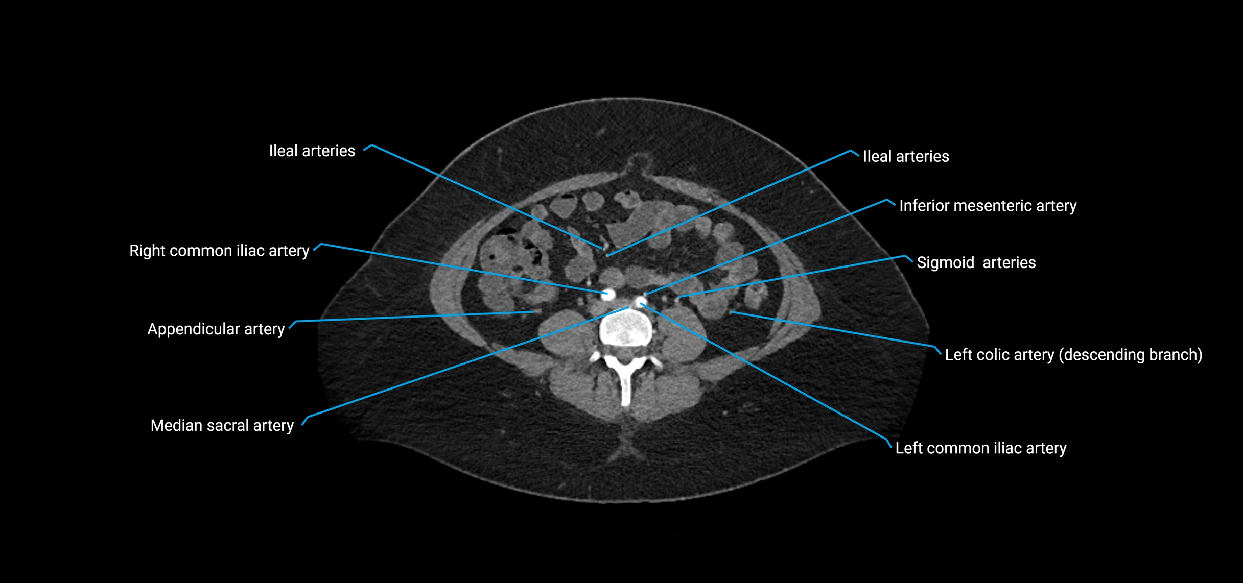 CTA abdomen axial cross sectional anatomy labelled image_144 (2).webp